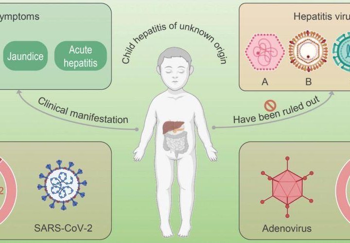 Severe Hepatitis of Unknown Origin in Children: Adenovirus or COVID-19 Infection?
