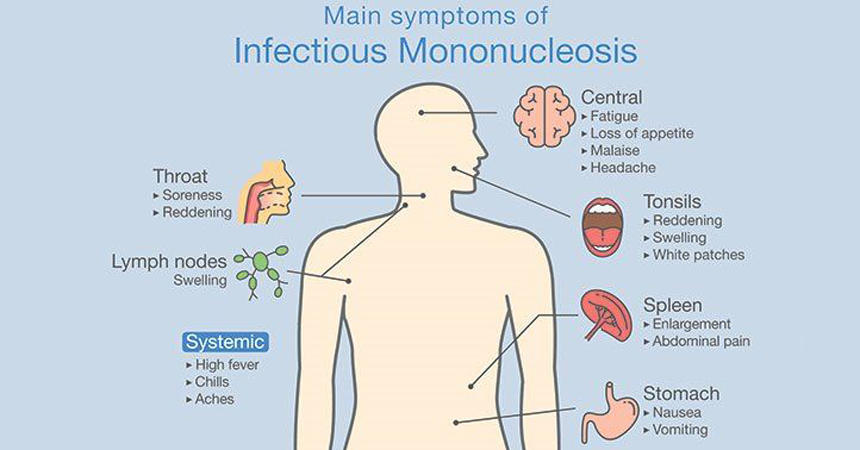 The Kissing Disease - Infectious Mononucleosis 