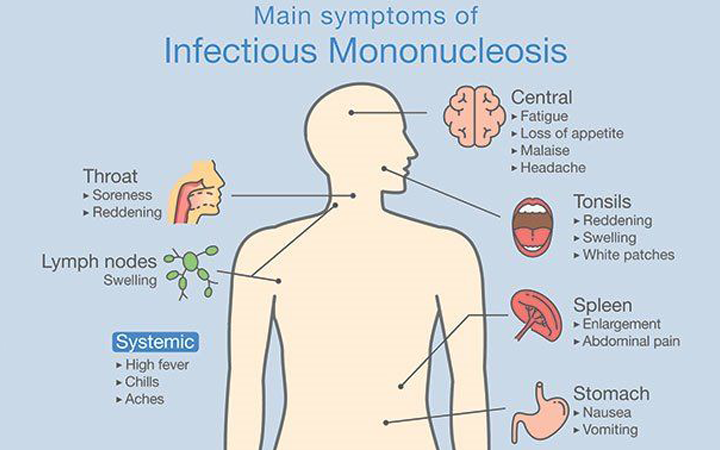 What is “Kissing Disease,” and Why Does EBV Screening Matter?